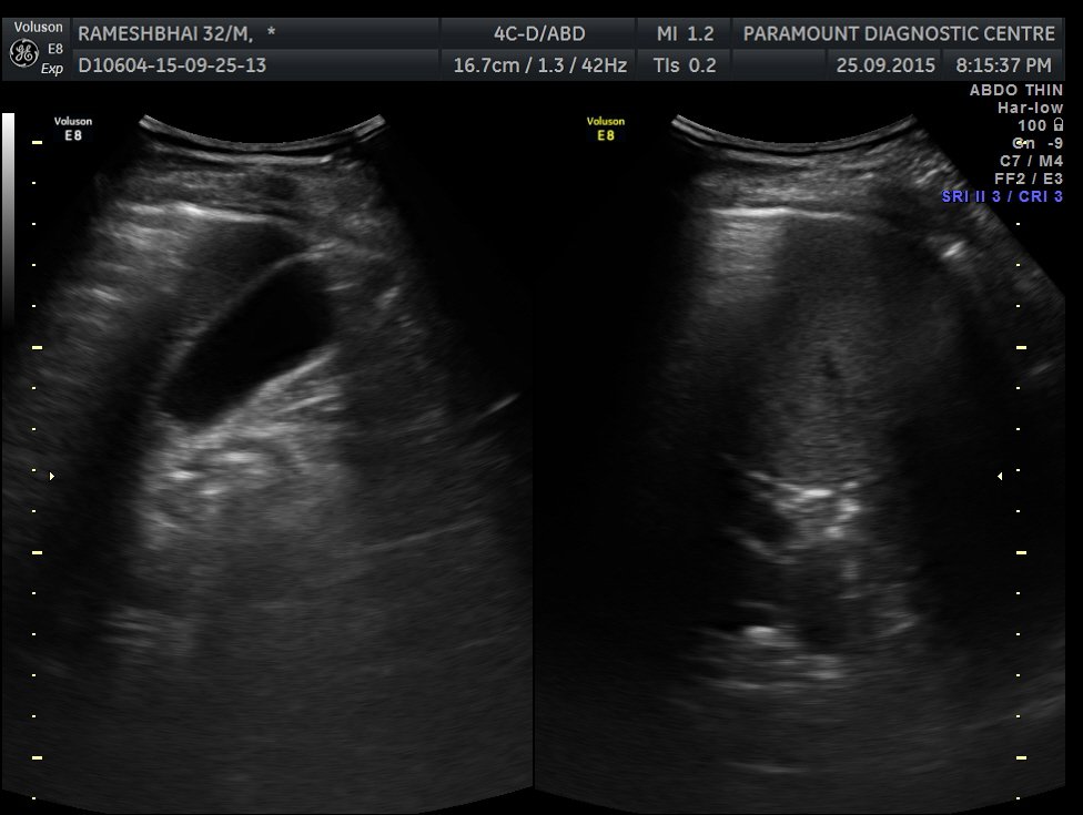 Case 1: Ruptured Appendicitis on X-Ray and Ultrasound