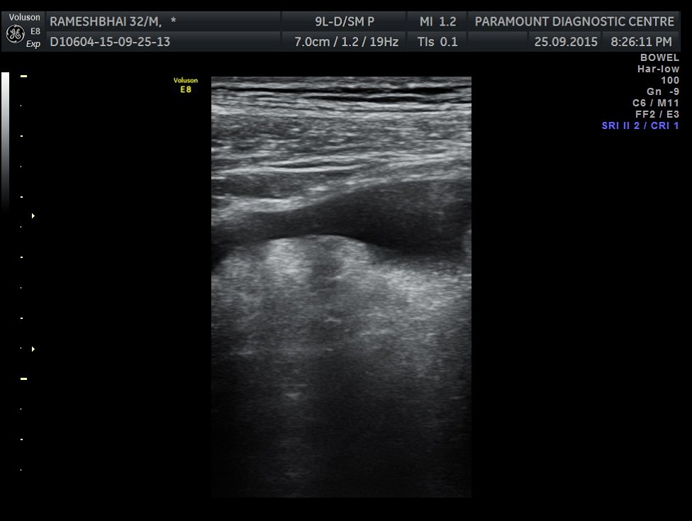 Case 1: Ruptured Appendicitis on X-Ray and Ultrasound