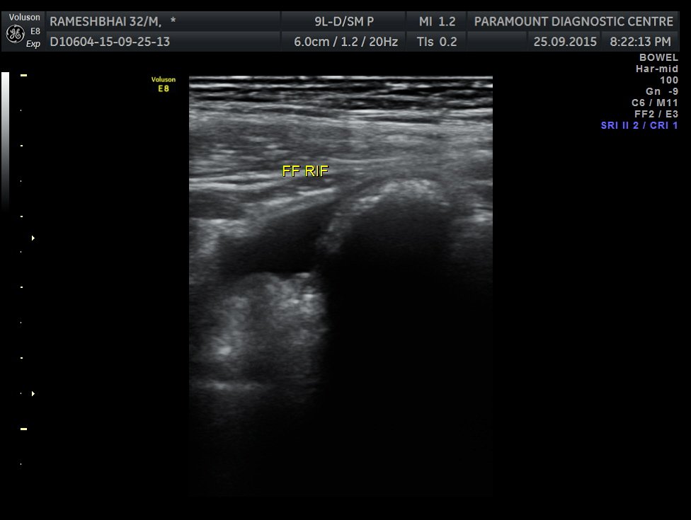 Case 1: Ruptured Appendicitis on X-Ray and Ultrasound