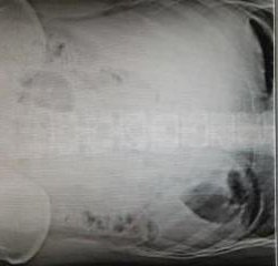 Case 1: Ruptured Appendicitis on X-Ray and Ultrasound